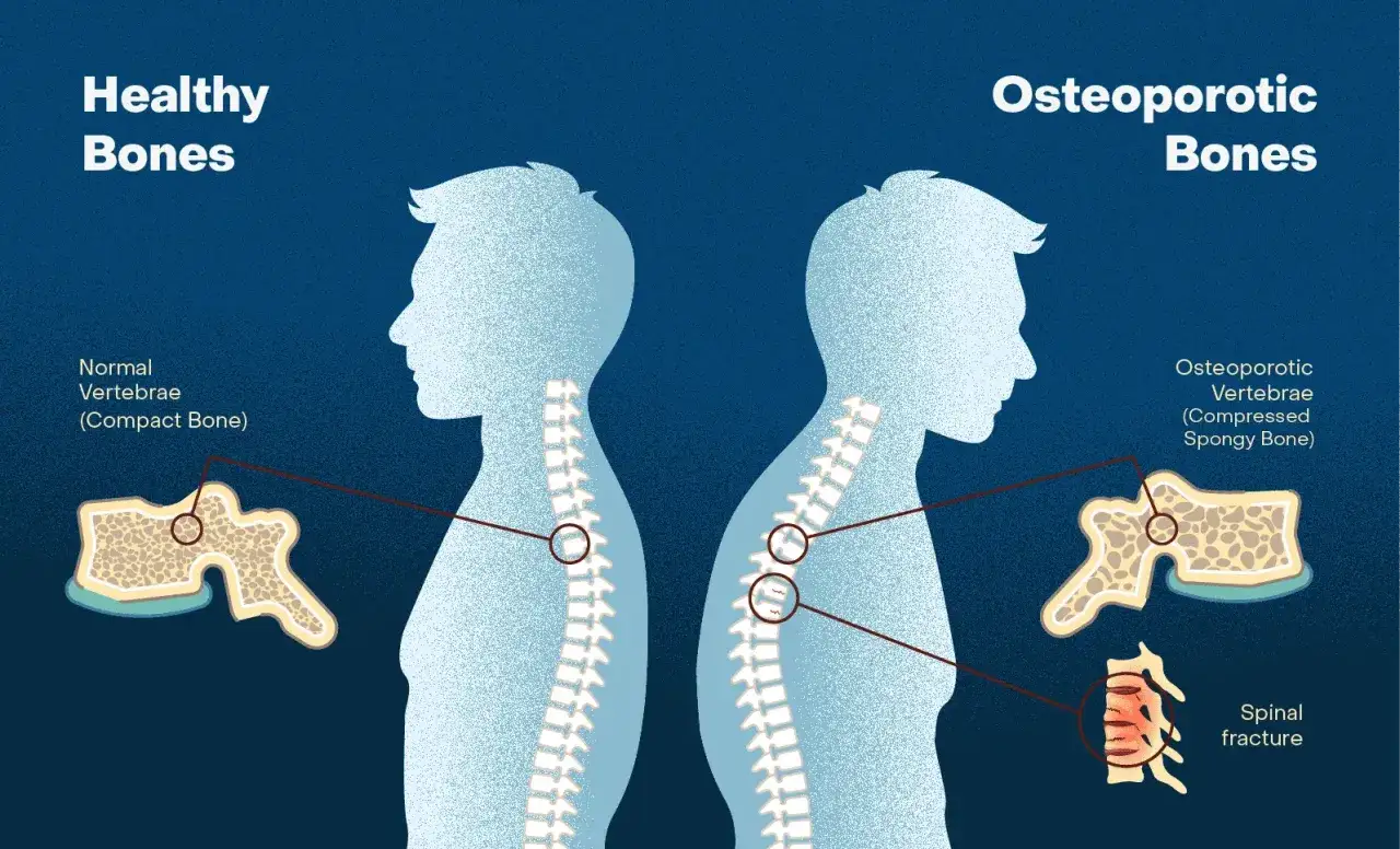 Porównanie zdrowych i osteoporotycznych kości. Osteoporoza powoduje ścieńczenie kości, zwiększając ryzyko złamań kręgów.