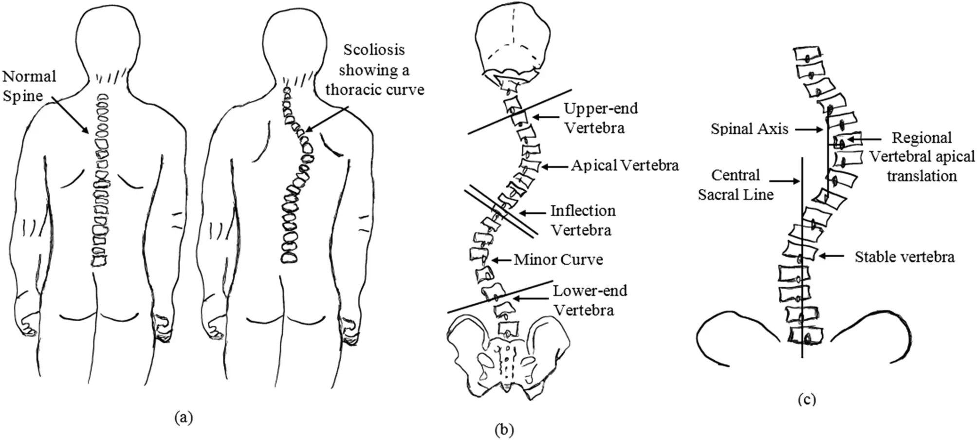 Illustrations comparant une colonne vertébrale normale et une scoliose, avec des schémas détaillant les courbes et les vertèbres, y compris la lordose.