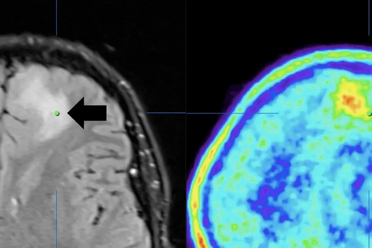 Obraz rezonansu magnetycznego mózgu z zaznaczonym obszarem guza, prawdopodobnie glejak wielopostaciowy, obok obrazu PET pokazującego aktywność metaboliczną.