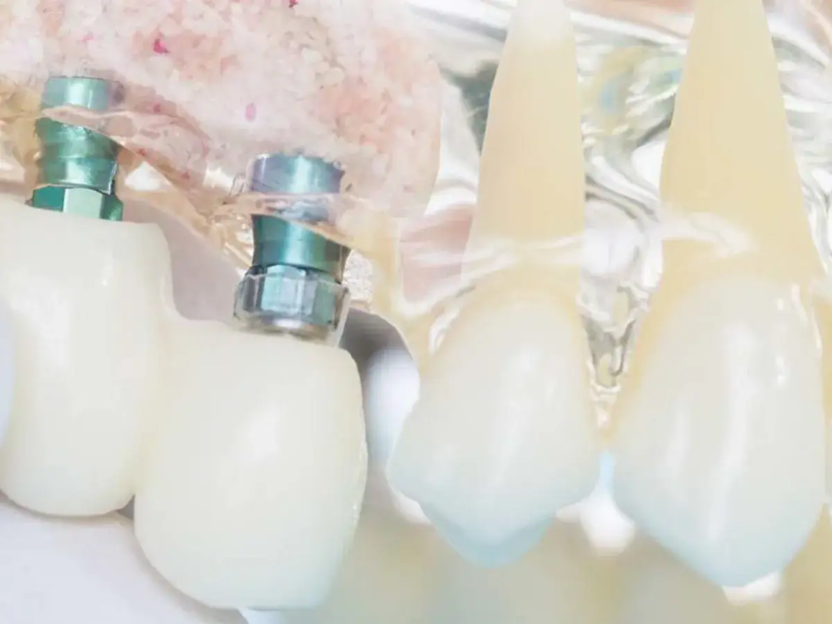 Model szczęki z implantami zębowymi, widoczne elementy mocowania i korony. Model symuluje odrzucenie implantu zęba.