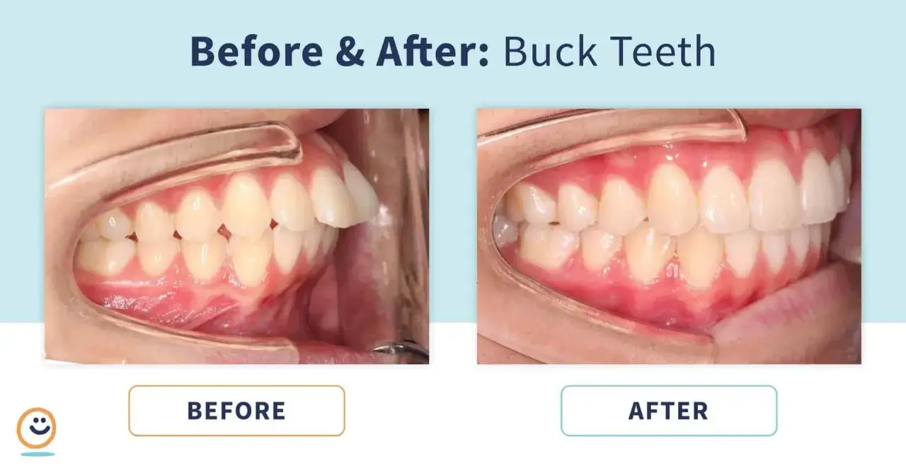 Antes y despu&eacute;s: dientes inclinados hacia afuera. La imagen muestra una correcci&oacute;n dental exitosa.