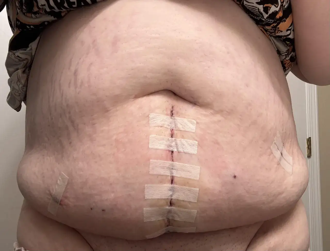 Brzuch po laparotomii z widoczną blizną pooperacyjną zabezpieczoną plastrami. Skóra ma liczne rozstępy.