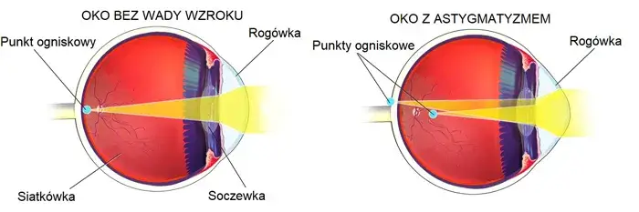 r&oacute;żne metody korekcji astygmatyzmu grafika