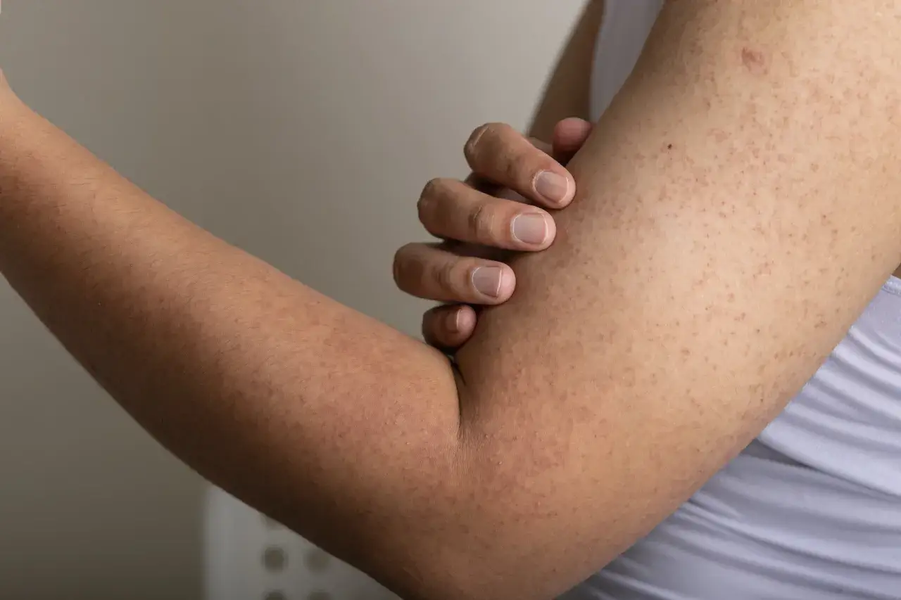 Gros plan sur un bras présentant des petites bosses rouges et rugueuses, typiques de la kératose pilaire.
