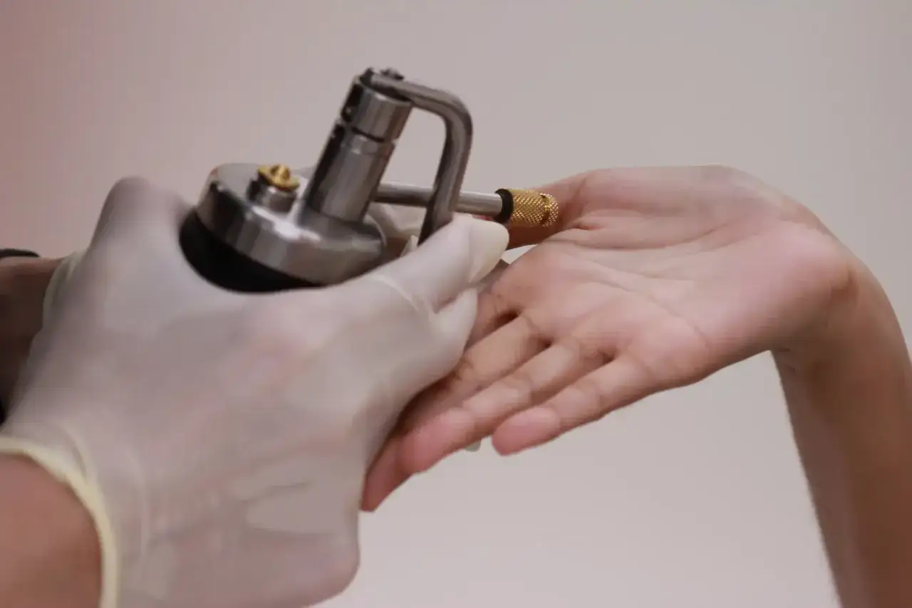 Traitement d'une verrue par cryothérapie. Un professionnel de santé utilise un appareil de **azote liquide** pour congeler la **verrue** sur la main d'un patient.