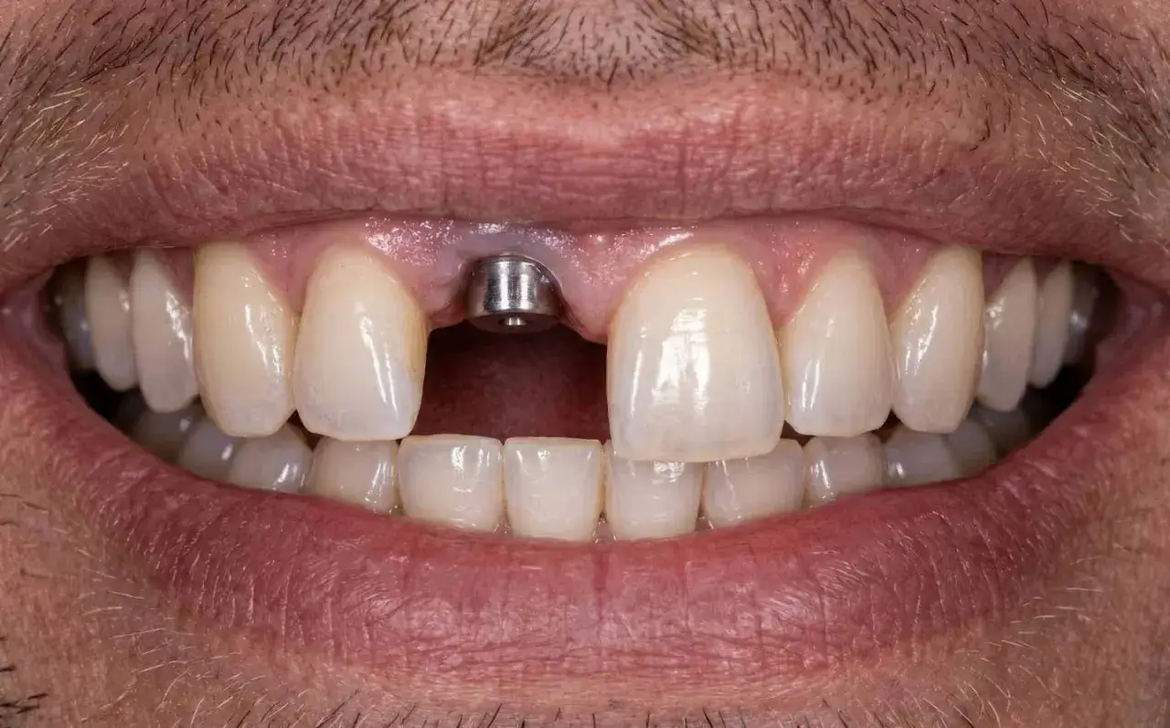 Implant zębowy w trakcie leczenia. Dowiedz się, gdzie zrobić protezę zębową na NFZ.