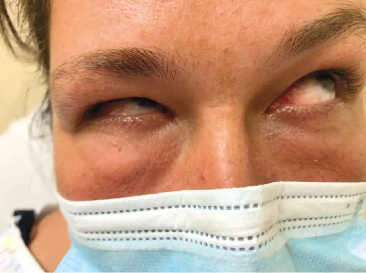 Augen mit abnormaler Bewegung und R&ouml;tung, m&ouml;gliche Symptome eines Vitamin B12-Mangels.