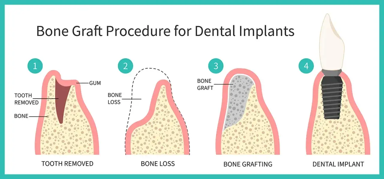 Ilustraci&oacute;n muestra el proceso de injerto &oacute;seo para implantes dentales: extracci&oacute;n, p&eacute;rdida &oacute;sea, poner hueso en la enc&iacute;a y colocaci&oacute;n del implante.
