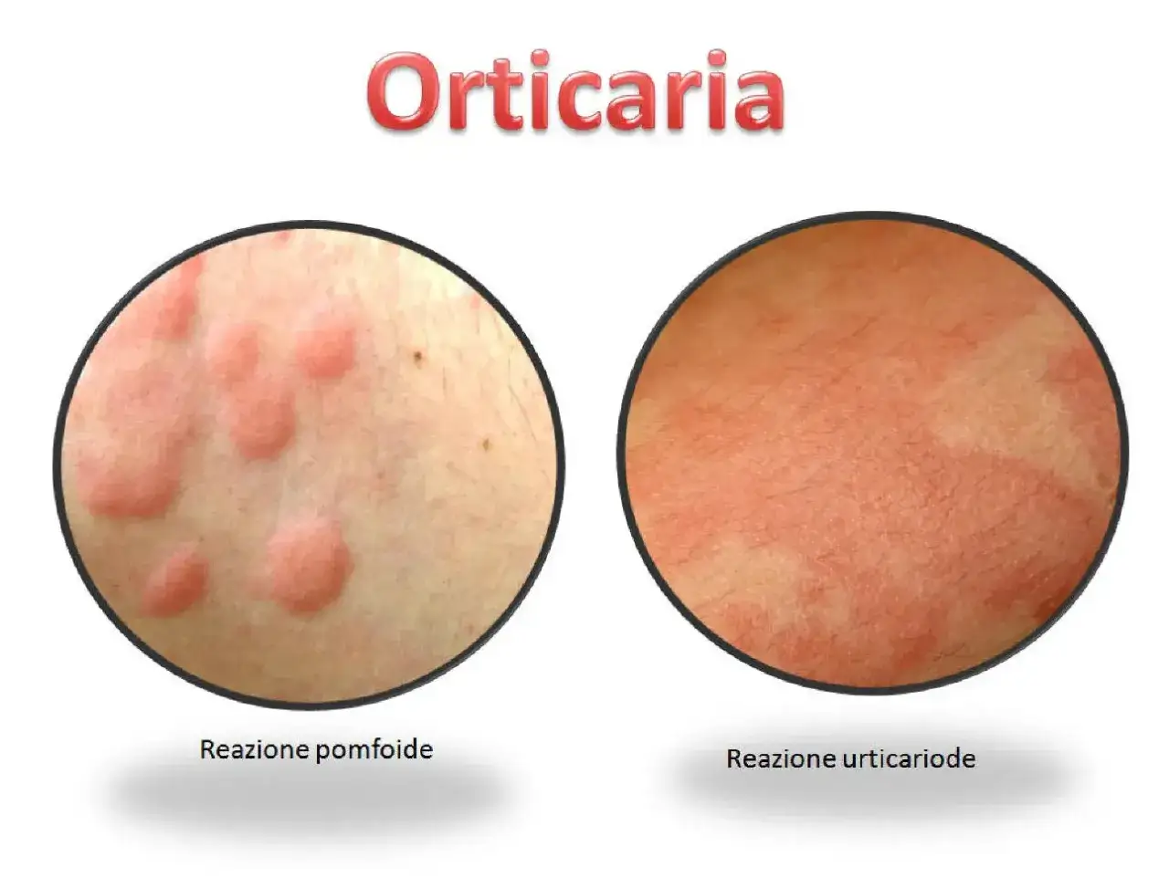 Immagine mostra orticaria, con reazioni pomfoidi e urticarioidi. Scopri come curarla.