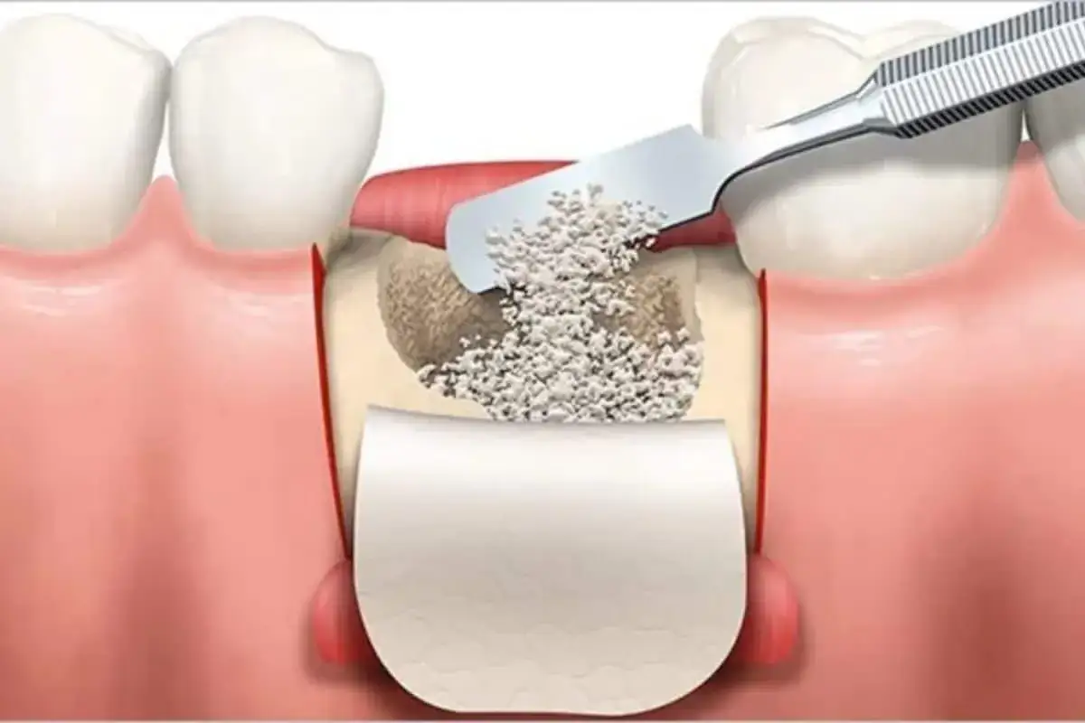 Illustrazione di un innesto osseo dentale. Si vede la preparazione del sito e l'inserimento di materiale osseo. Gli effetti collaterali sono rari.