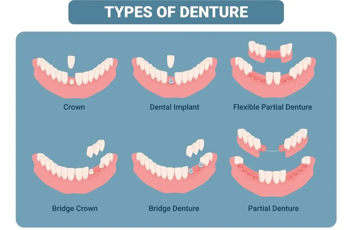 Ilustraci&oacute;n muestra soluciones para la falta de dientes: coronas, implantes, puentes y dentaduras.