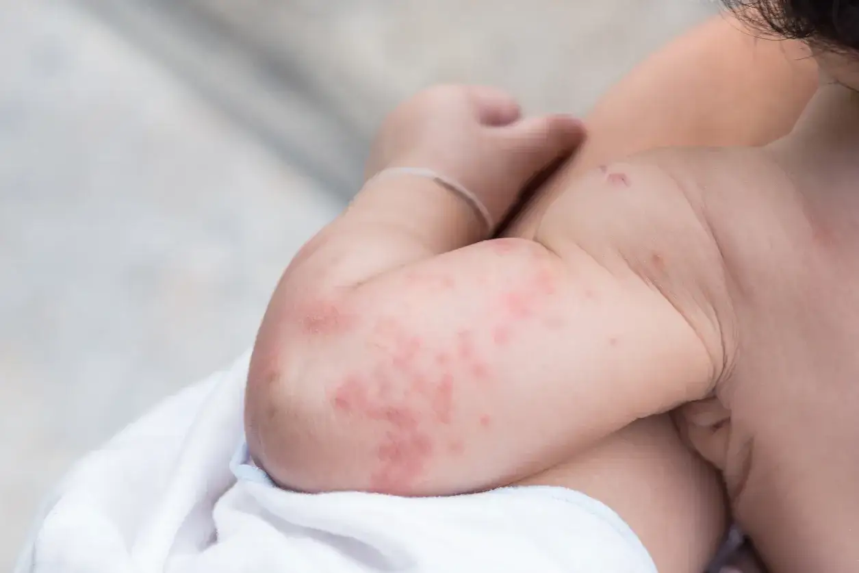 Braccio di un bambino con eruzione cutanea rossa e pruriginosa, che potrebbe essere scambiata per falsa scabbia.