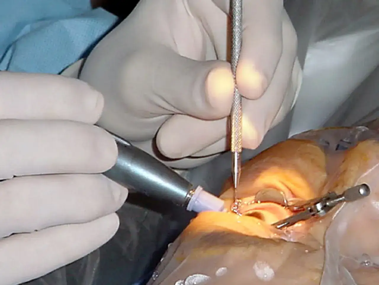 Chirurgia oculare per cataratta con laser. Si valutano le controindicazioni per un intervento sicuro.