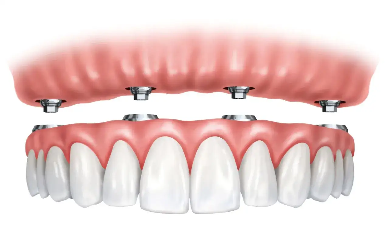 Arcata dentale superiore e inferiore con impianti. L'implantologia all on four offre una soluzione fissa e stabile per ripristinare il sorriso.