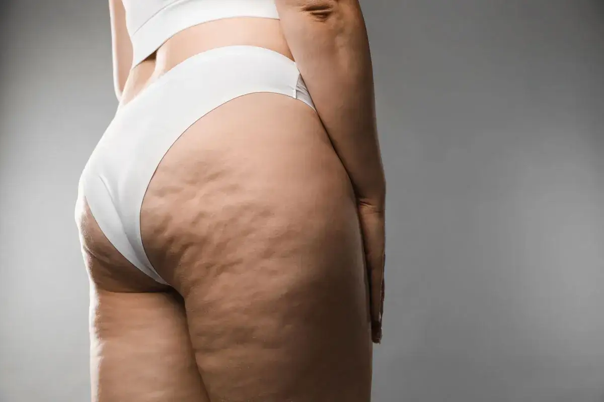 Detailaufnahme der Cellulite am Oberschenkel einer Frau. Viele fragen sich, ob und wie geht cellulite wieder weg.
