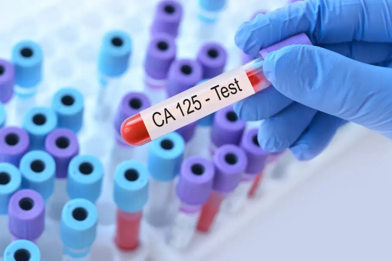 Rękawiczka trzyma probówkę z krwią do badania CA 125. To test diagnostyczny, często stosowany w monitorowaniu leczenia nowotworów.