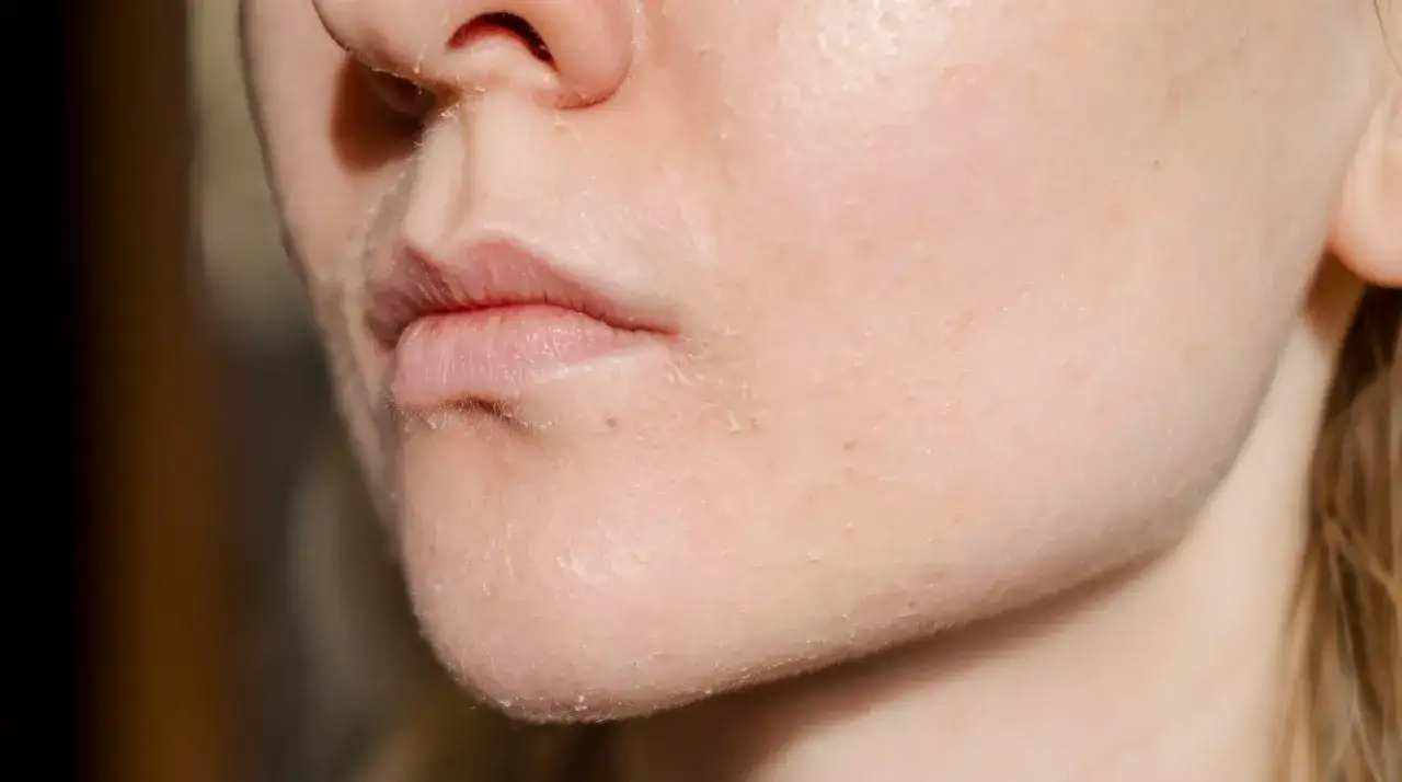 Primer plano de piel irritada alrededor de la boca, con descamación visible y sequedad.
