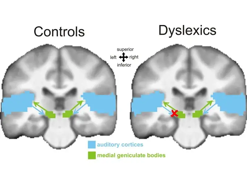 m&oacute;zg dyslektyka schemat