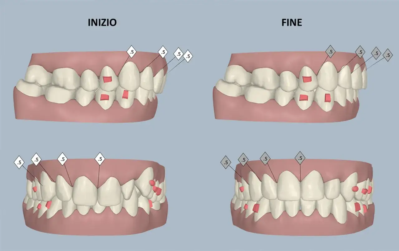 Modellazione 3D di denti con malocclusione 2 classe adulto, prima e dopo il trattamento ortodontico.