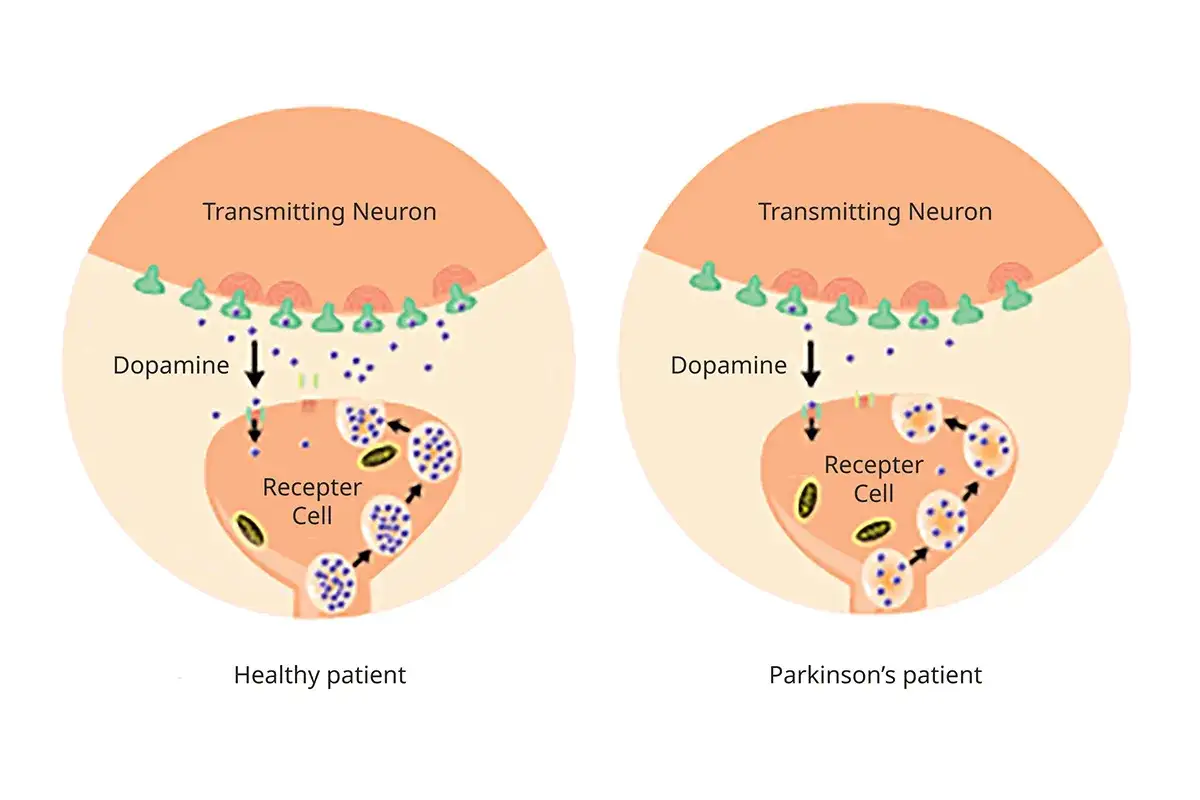 Schéma comparant la transmission neuronale chez un patient sain et un patient atteint de Parkinson, illustrant la diminution de dopamine. Le parkinson cause psychologique est complexe.
