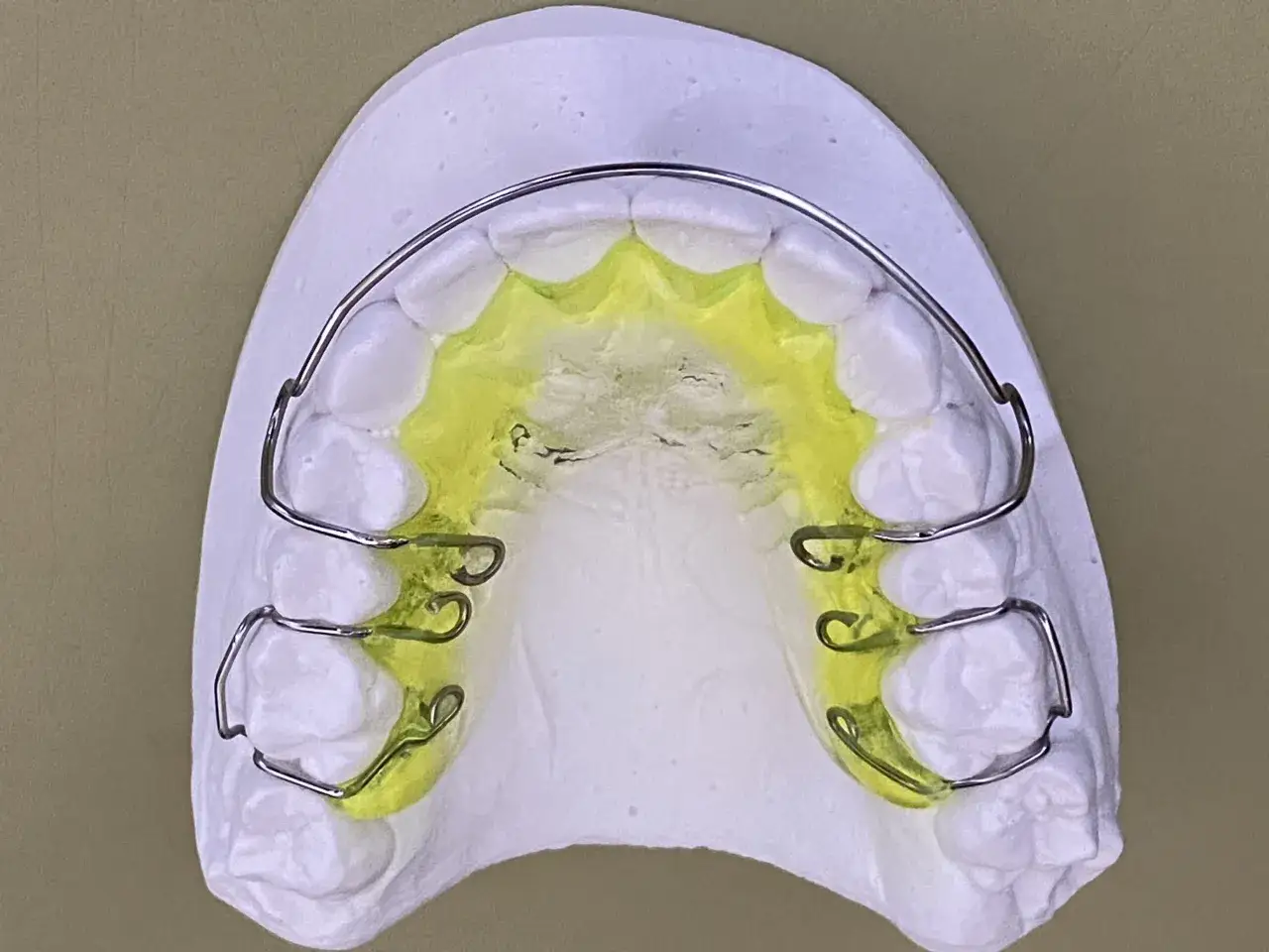 Placca di Hawley su modello dentale, con filo metallico e resina gialla.