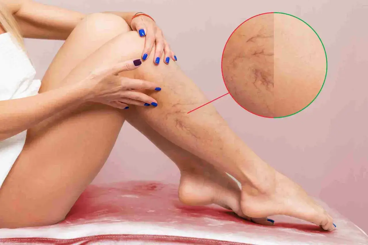 Gambe con teleangectasie, un possibile segno di trombofilia genetica. Un ingrandimento mostra la rete vascolare.