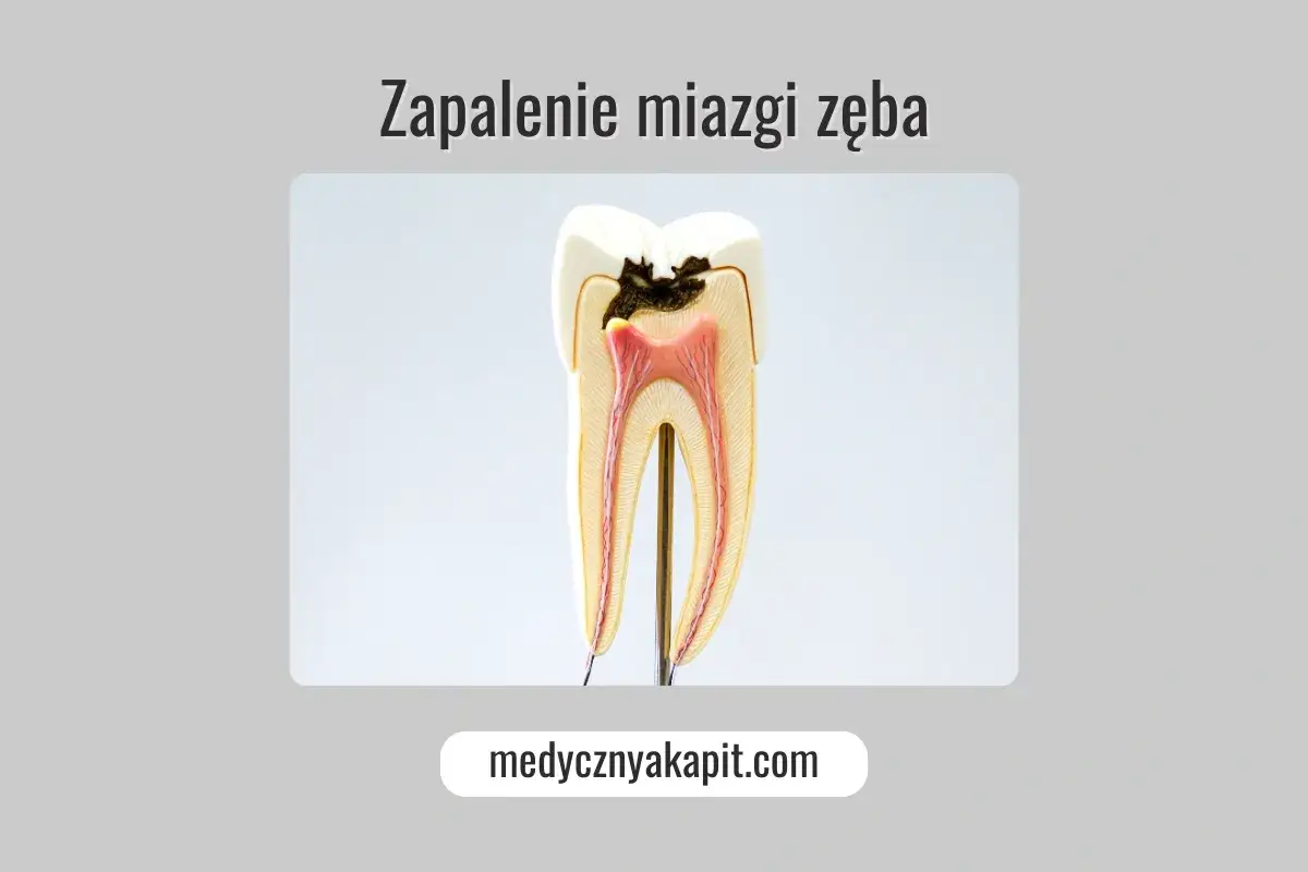 Model zęba z widocznym próchnicą i zapaleniem miazgi. Ciemna próchnica sięga do wnętrza zęba, gdzie znajduje się czerwona miazga.