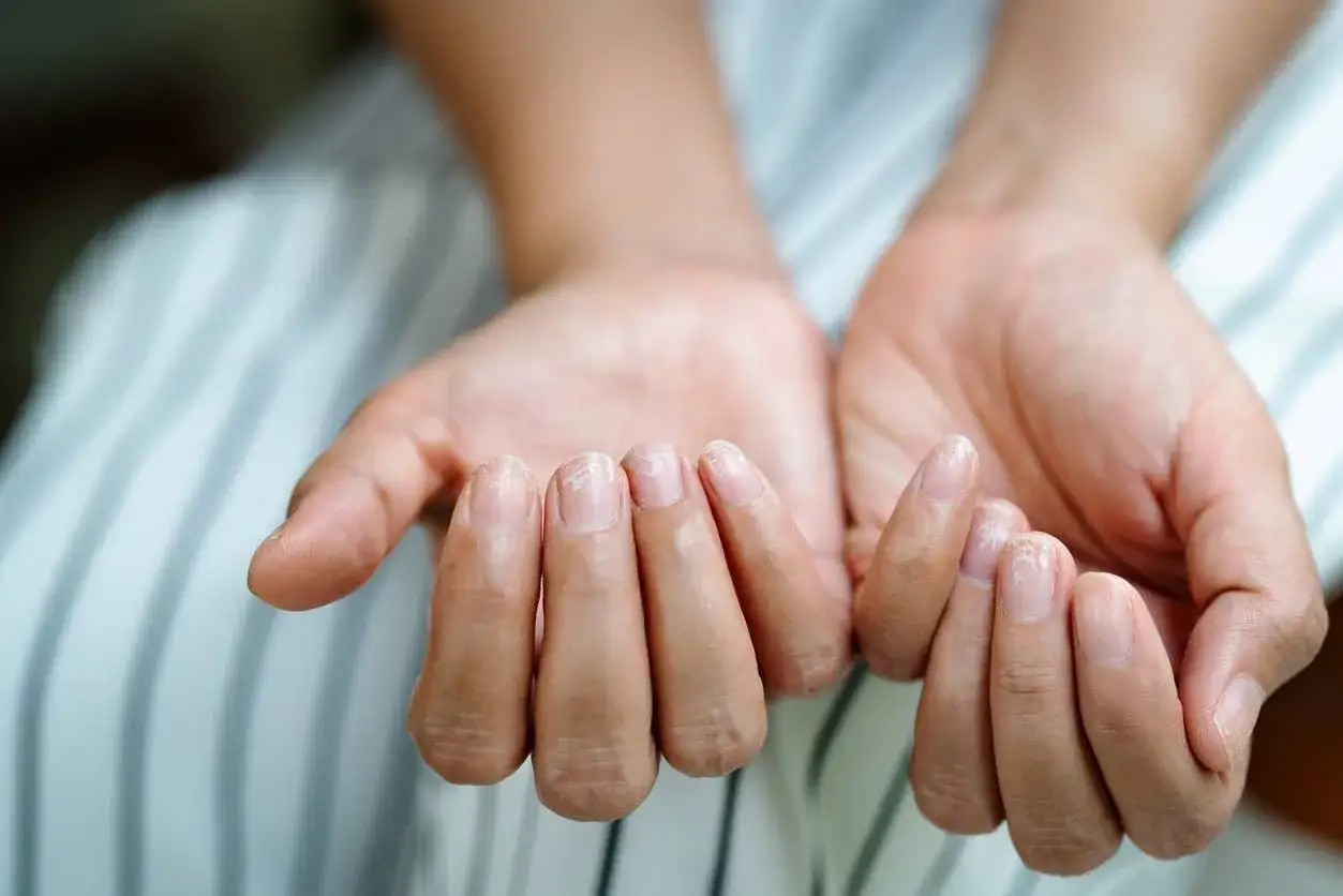 Mani con unghie rigate, che mostrano segni di secchezza e fragilit&agrave;.