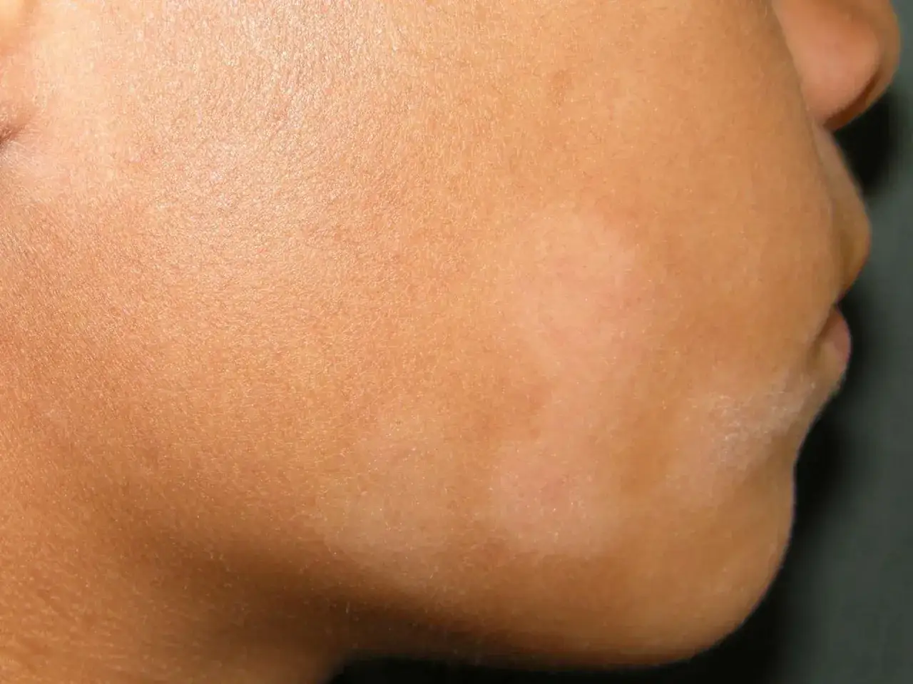Primer plano de la mejilla de un niño con manchas blancas en la piel, posiblemente vitíligo o pitiriasis alba.
