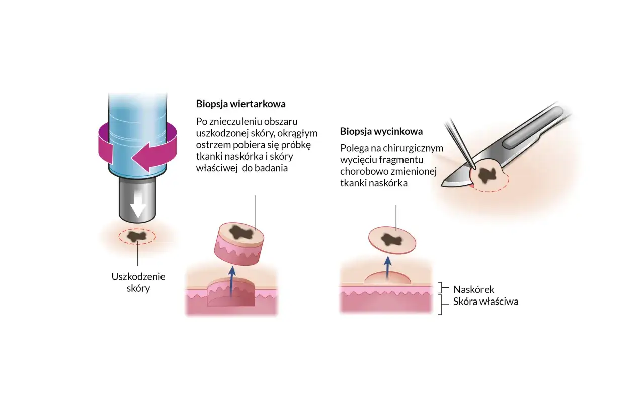 Ilustracja pokazuje, co to jest biopsja: wiertarkowa pobiera próbkę okrągłym ostrzem, a wycinkowa chirurgicznie wycina fragment tkanki.