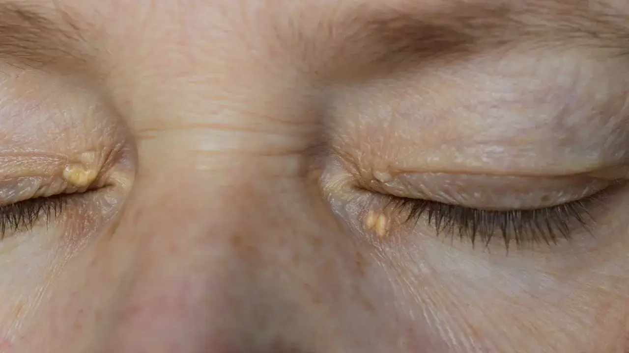 Żółtawe zmiany skórne, tzw. xanthelasma, widoczne na powiekach.