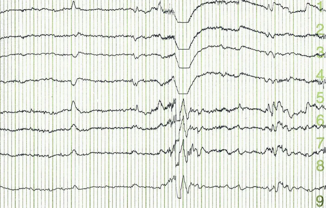 EEG-Aufzeichnung zeigt einen Krampfanfall, aber keine typischen epileptischen Muster. Die Wellen sind unregelm&auml;&szlig;ig und zeigen eine pl&ouml;tzliche Aktivit&auml;t.