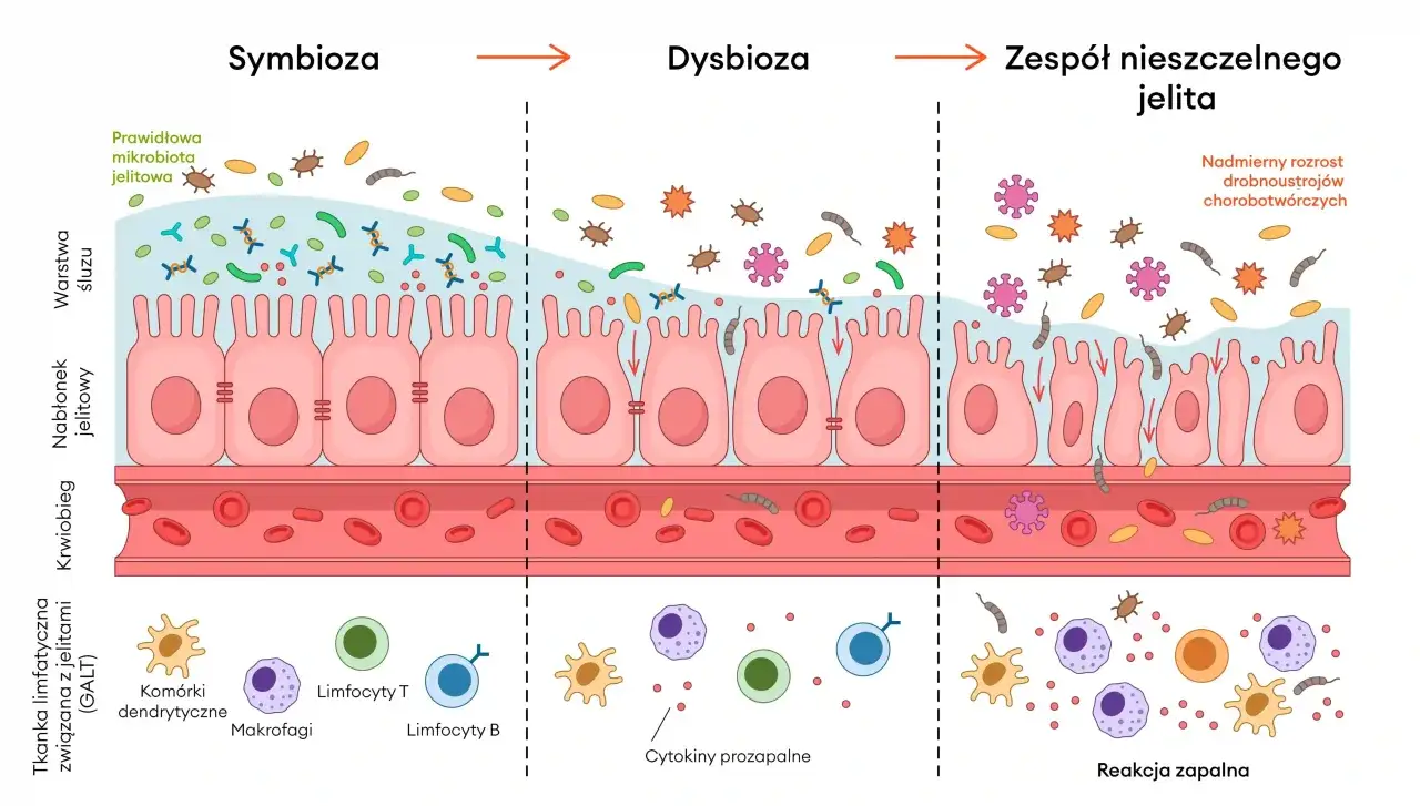 Ilustracja pokazuje przejście od symbiozy jelitowej do dysbiozy i zespołu nieszczelnego jelita, gdzie nadmiar drobnoustrojów chorobotwórczych wywołuje reakcję zapalną.