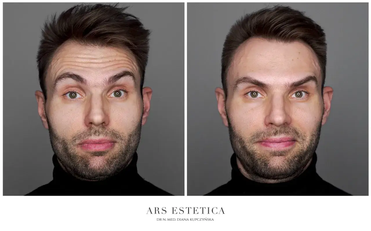 botoks przed i po naturalny efekt