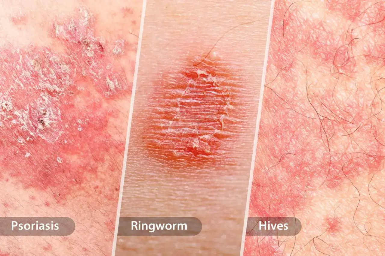 Gros plan sur trois affections cutanées : psoriasis avec plaque sèche, mycose et urticaire.