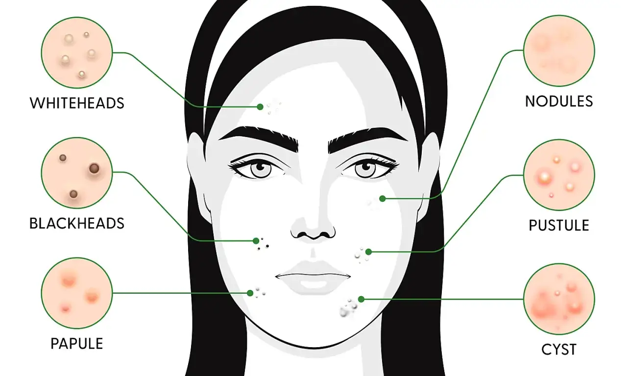 Illustration av olika typer av finnar: whiteheads, blackheads, papules, pustules, nodules och cystor. Undvik att trycka finnar för att förhindra ärrbildning.