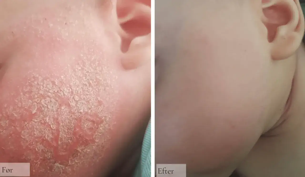 F&ouml;re och efter-bilder visar tydligt hur eksem i ansiktet kan lindras.
