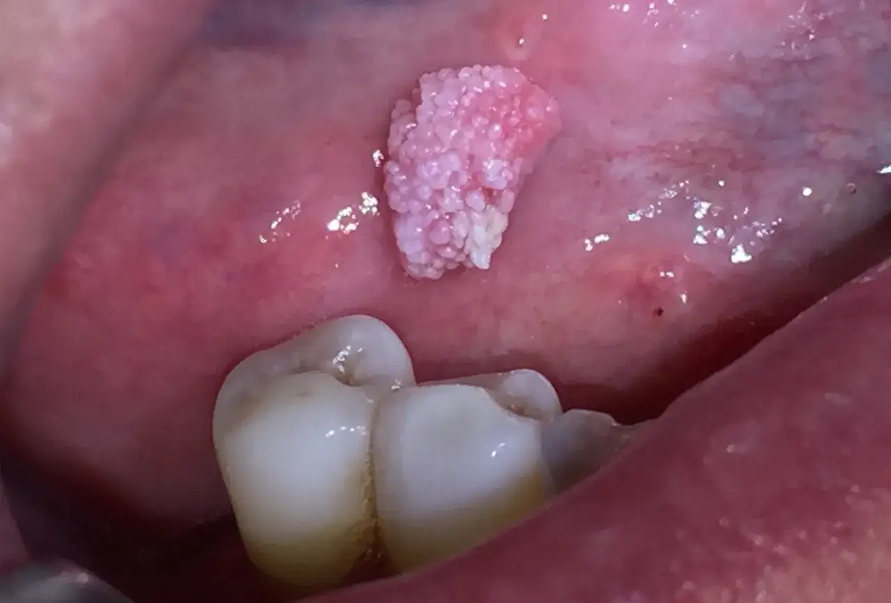 Papilloma squamoso rosa sulla mucosa orale, possibile manifestazione di hpv bocca. Vicino a un dente.