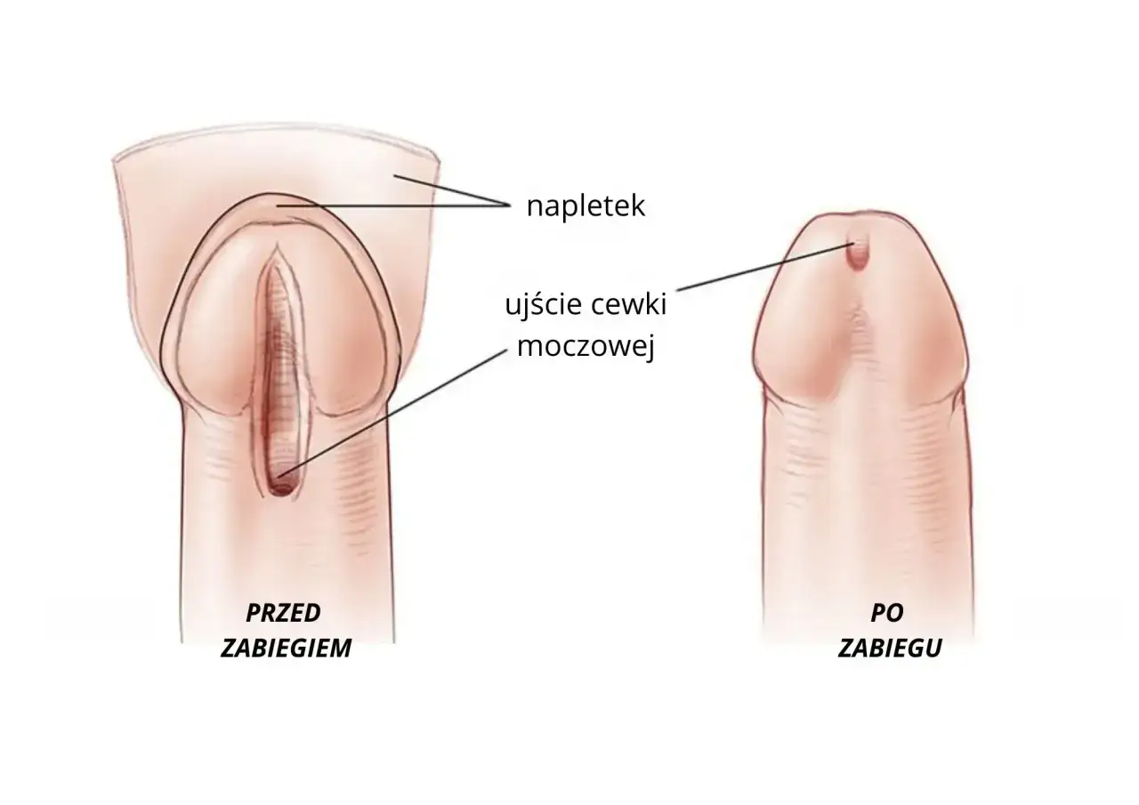Przed zabiegiem ujście cewki moczowej jest wąskie, co może wskazywać na zwężenie cewki moczowej. Po zabiegu ujście jest szersze.