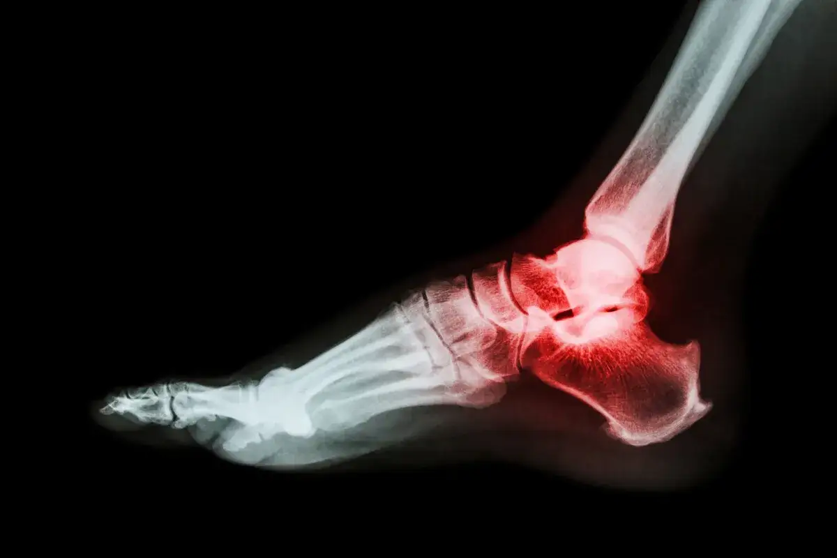 anatomia kości piętowej złamanie