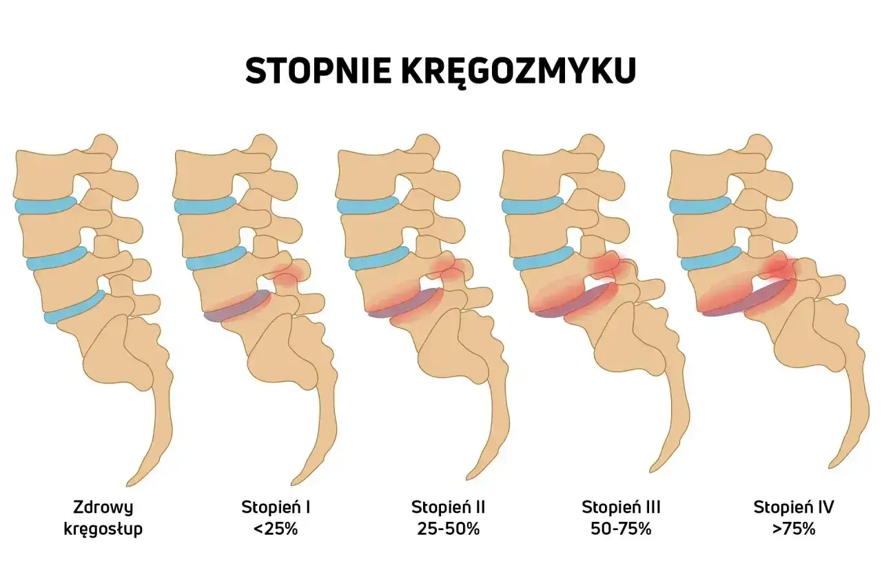 Ilustracja pokazuje stopnie kręgozmyku, od zdrowego kręgosłupa do zaawansowanych zmian, uwidaczniając objawy przesunięcia kręgów.