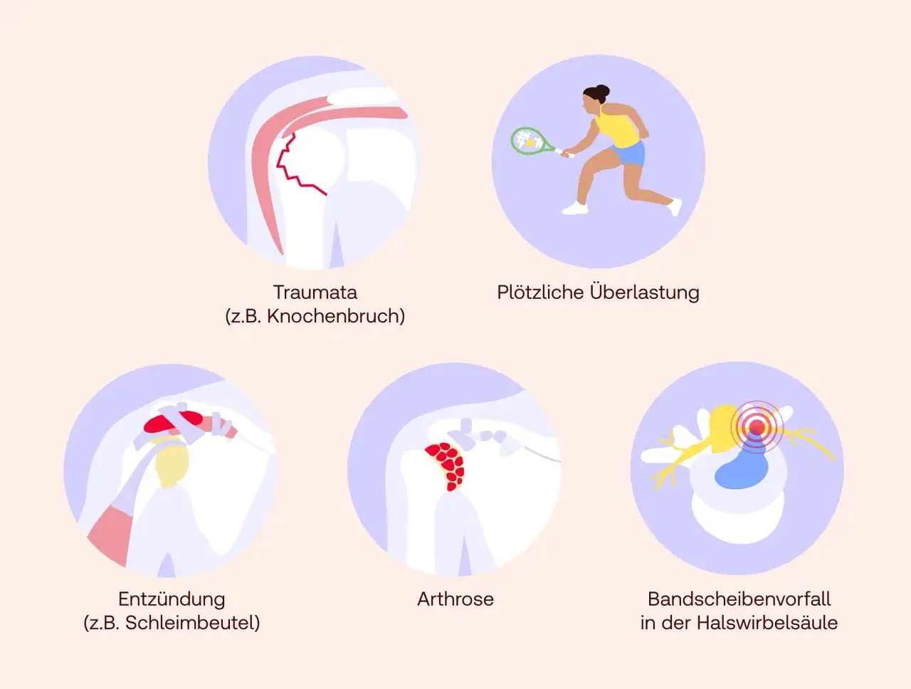 Schulterprobleme wie Traumata, Überlastung, Entzündung, Arthrose oder ein Bandscheibenvorfall können zu teres minor Schmerzen führen.