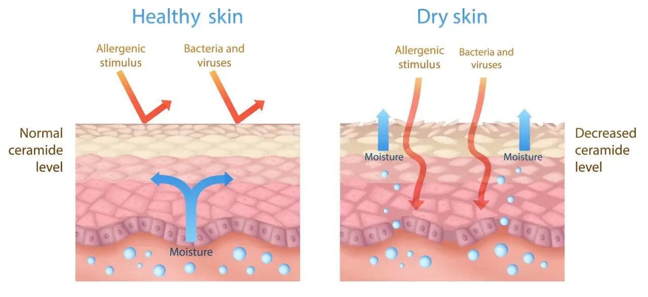 Illustration visar hur friska hudbarri&auml;rer med normala ceramider skyddar mot allergener. Torr hud med l&aring;ga ceramider sl&auml;pper ut fukt.