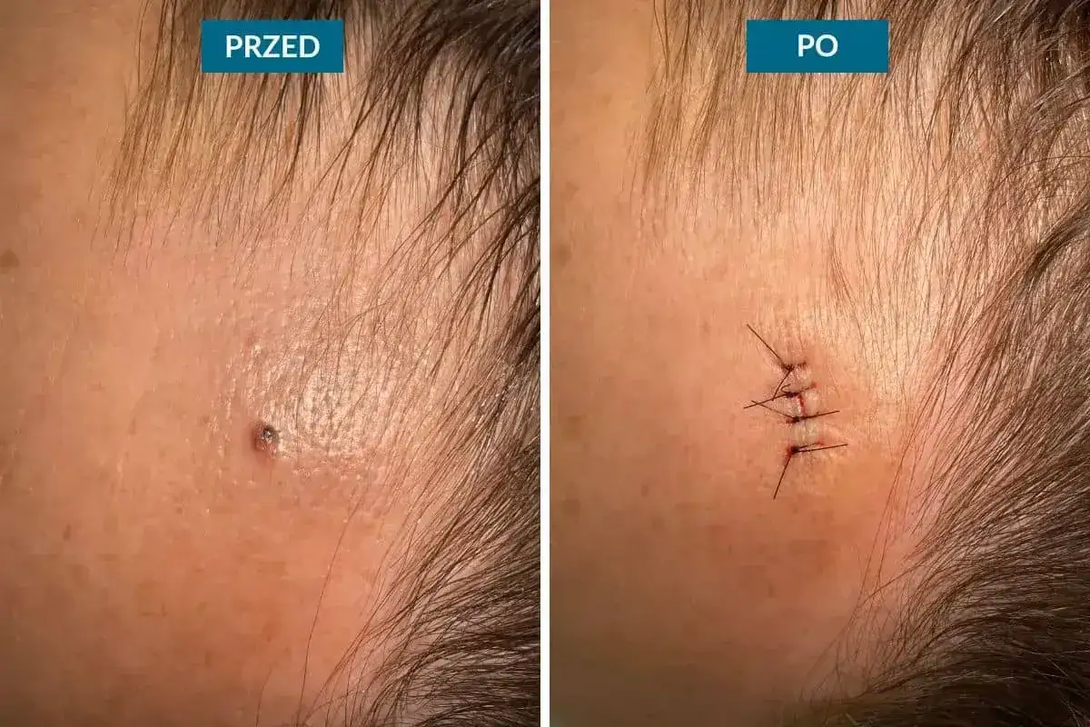 Przed i po usunięciu pieprzyka na czole. Widoczne blizny po zabiegu.