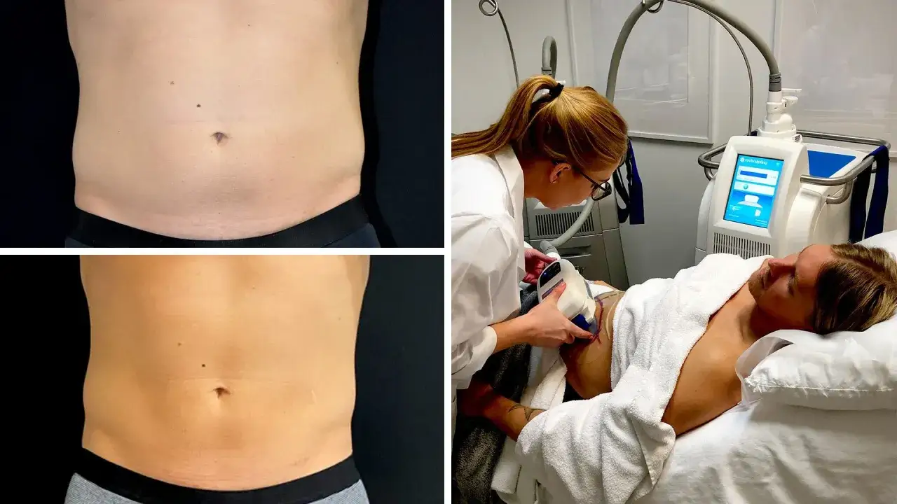 F&ouml;re- och efterbilder p&aring; en mage som genomg&aring;tt coolsculpting. En kvinna utf&ouml;r behandlingen p&aring; en liggande man.