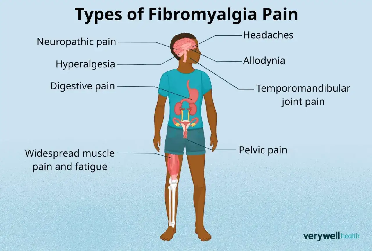 Illustration zeigt Fibromyalgie Symptome: Kopfschmerzen, neuropathische Schmerzen, Hyperalgesie, Verdauungsschmerzen, Kiefergelenkschmerzen, Beckenschmerzen, weit verbreitete Muskelschmerzen & Müdigkeit.