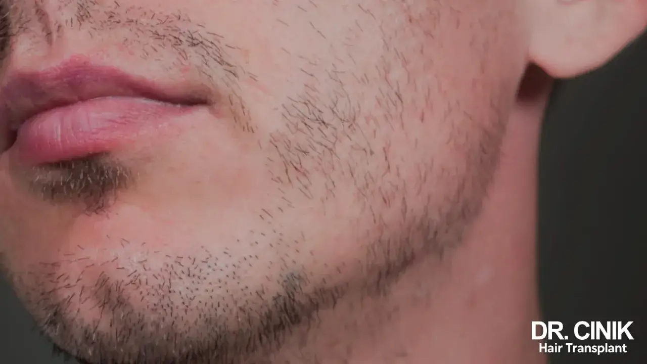 Primer plano de un hombre con barba poco poblada larga, mostrando el vello facial incipiente y los labios.