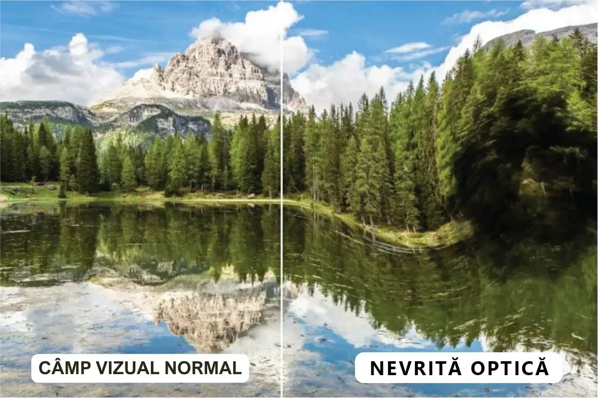 Obraz porównuje normalne pole widzenia z tym, jak widzi osoba z zapaleniem nerwu wzrokowego – obraz jest zniekształcony.