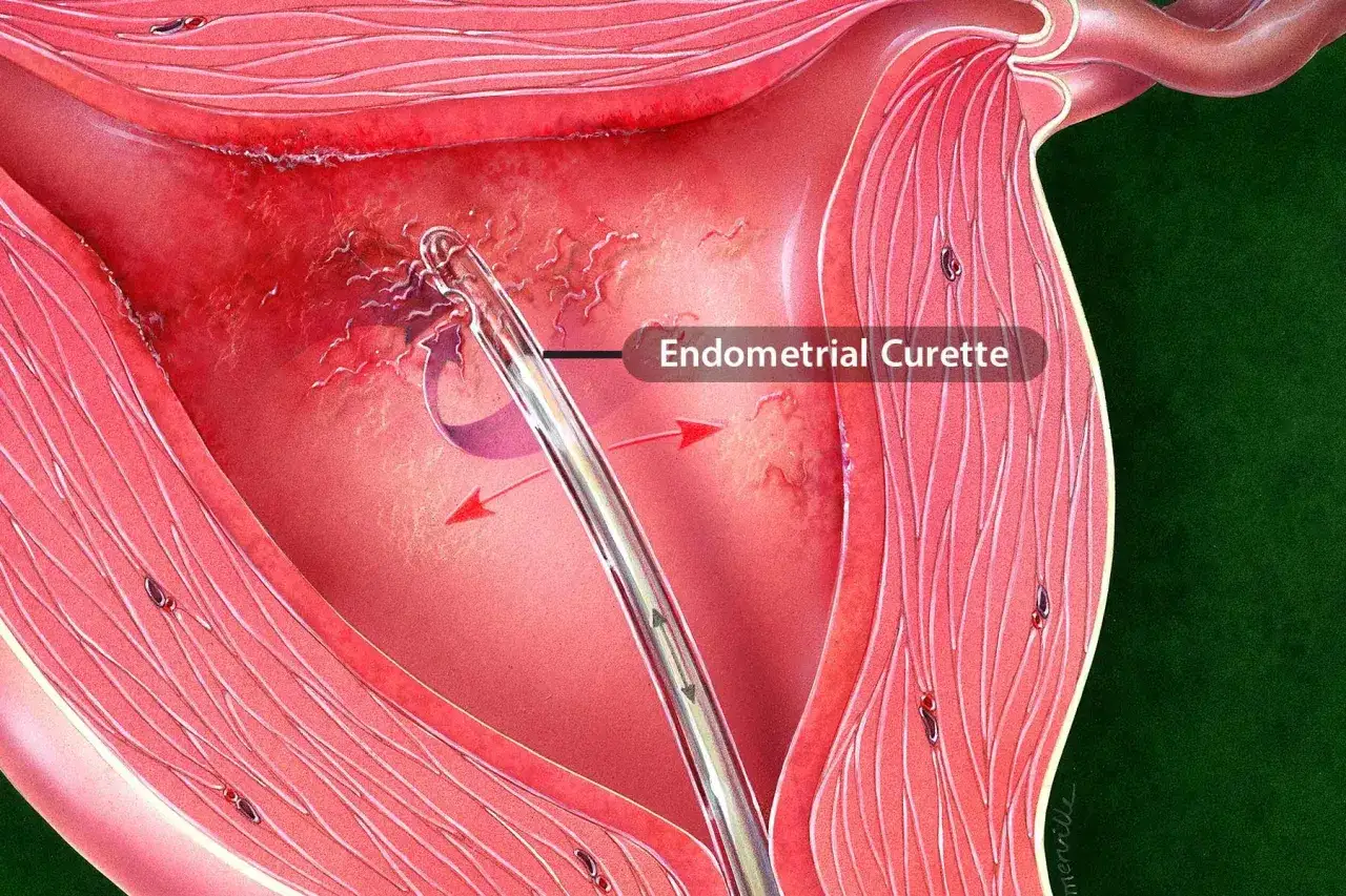 Eine Endometrium-K&uuml;rette entnimmt Gewebe zur Untersuchung. Dies ist ein Schritt bei der Diagnose, was eine Biopsie ist.