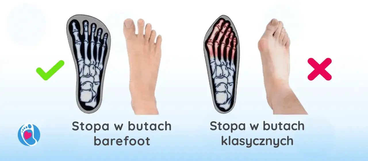 obuwie na haluksy vs szpilki